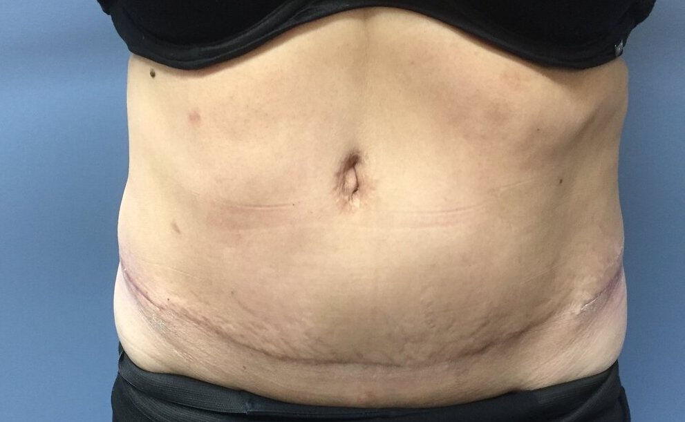 Patient C - Post-Operative Back & Bra line and Hips Liposuction — Dr  Giuffre Plastic Surgeon Edmonton