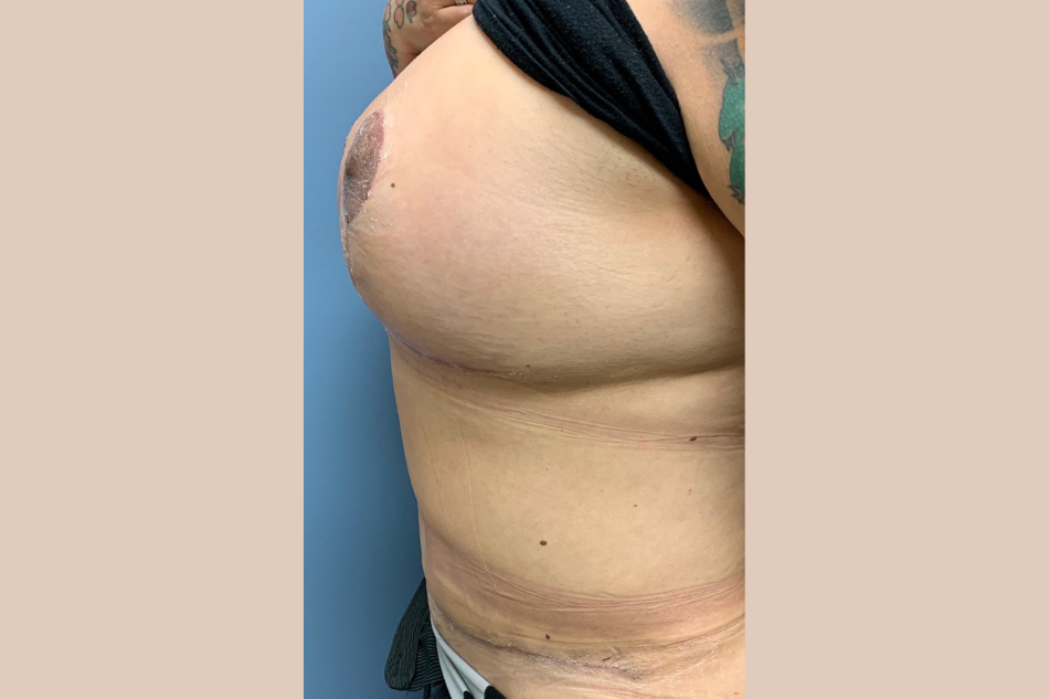 Patient O - 6 weeks Post-Operative Breast Augmentation, Breast Lift and  Tummy Tuck — Dr Giuffre Plastic Surgeon Edmonton