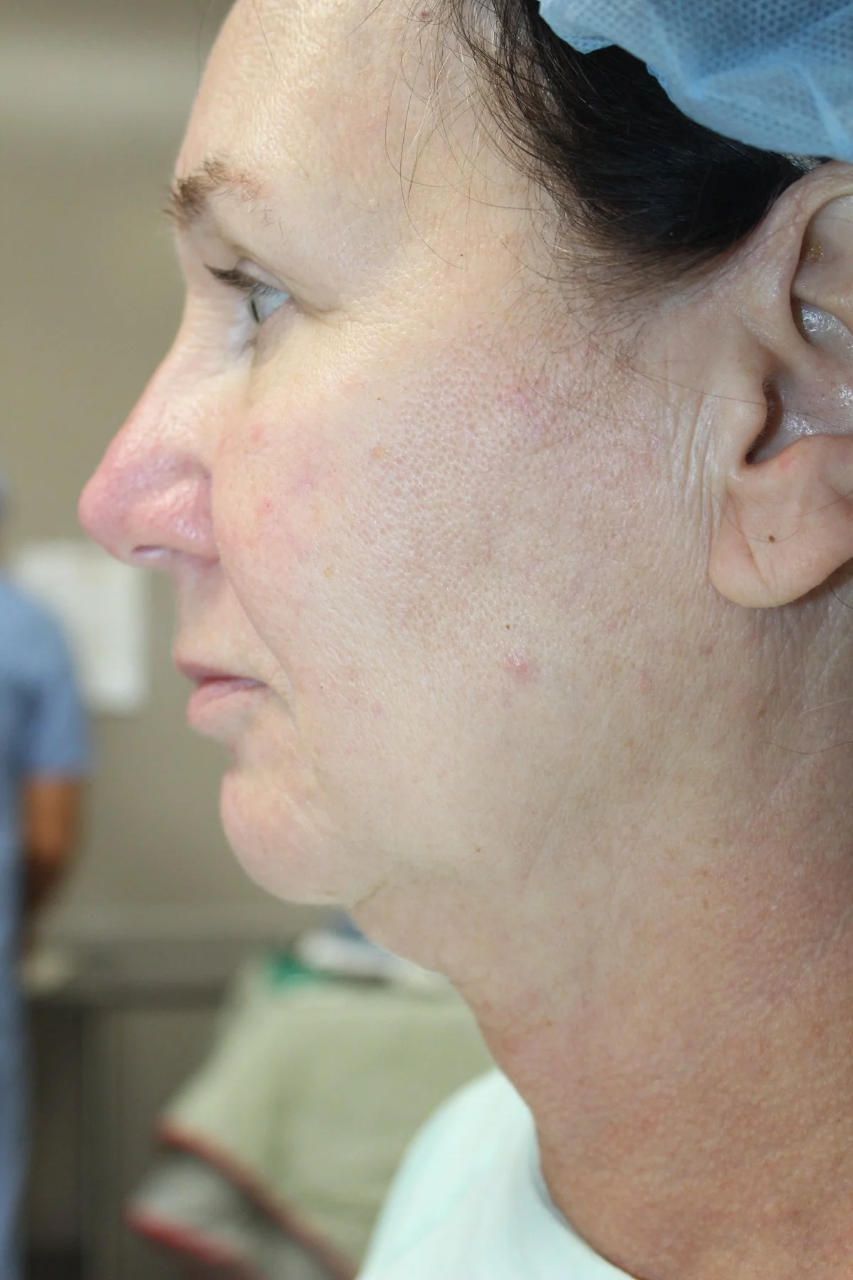 Patient N Preoperative Facelift — Dr Giuffre Plastic Surgeon Edmonton