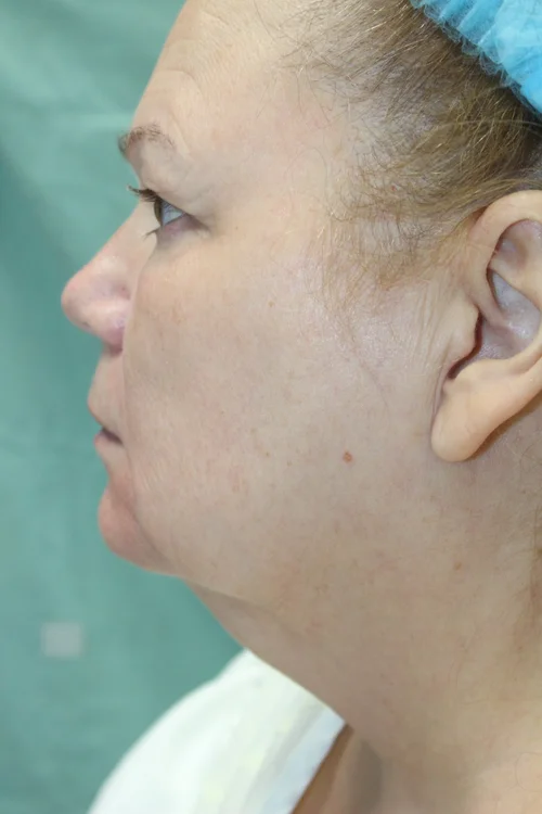 Patient K Preoperative Facelift — Dr Giuffre Plastic Surgeon Edmonton