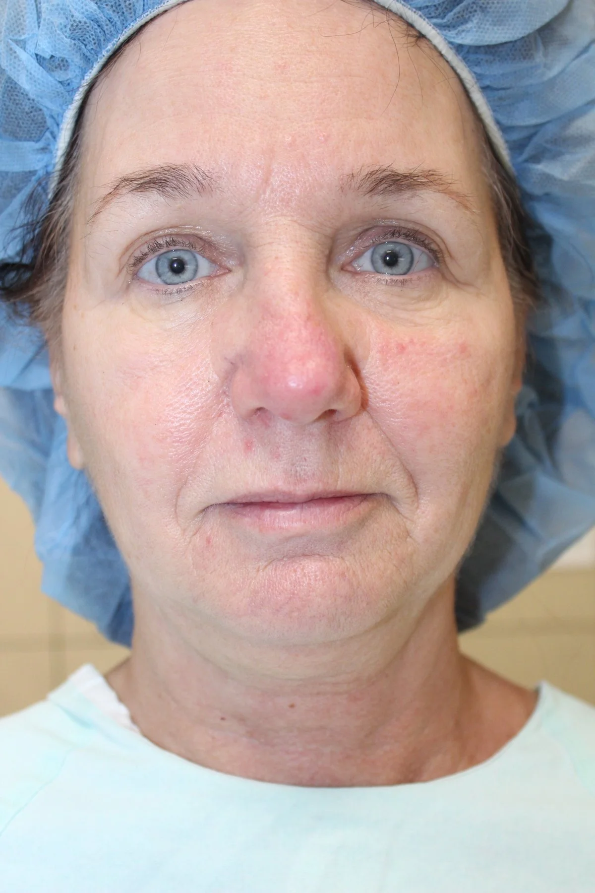 Patient N Preoperative Facelift — Dr Giuffre Plastic Surgeon Edmonton