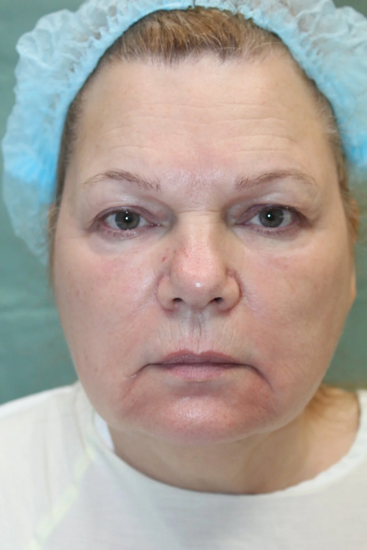 Patient K Preoperative Facelift — Dr Giuffre Plastic Surgeon Edmonton