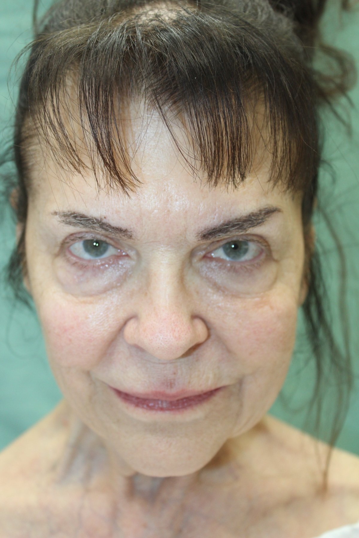 Patient I Preoperative Facelift — Dr Giuffre Plastic Surgeon Edmonton