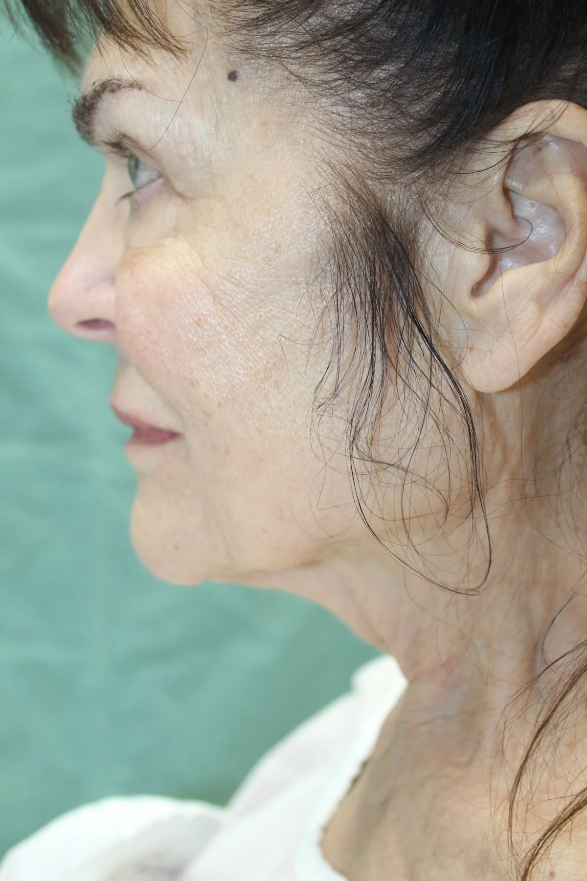 Patient I Preoperative Facelift — Dr Giuffre Plastic Surgeon Edmonton