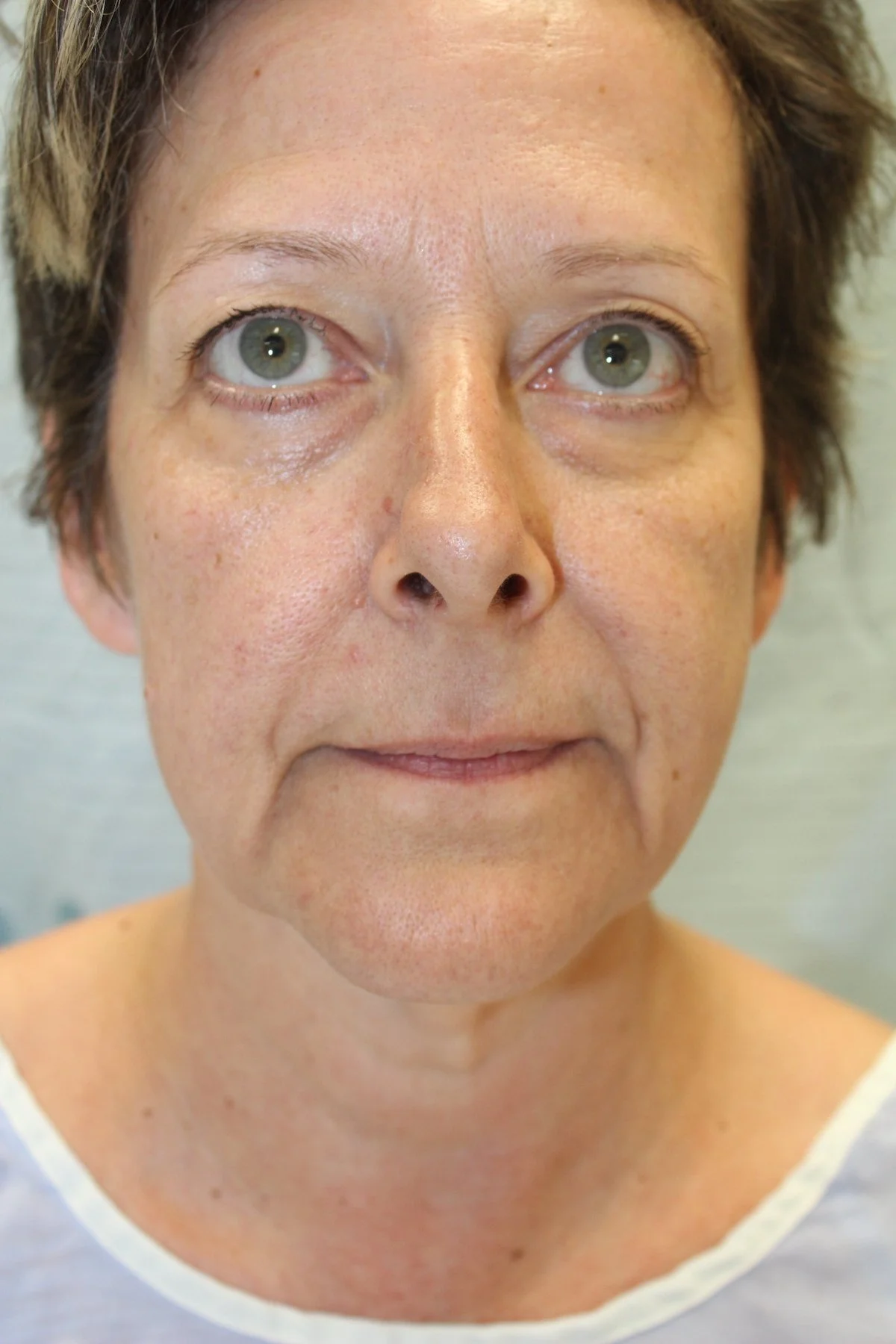 Patient H Preoperative Facelift — Dr Giuffre Plastic Surgeon Edmonton