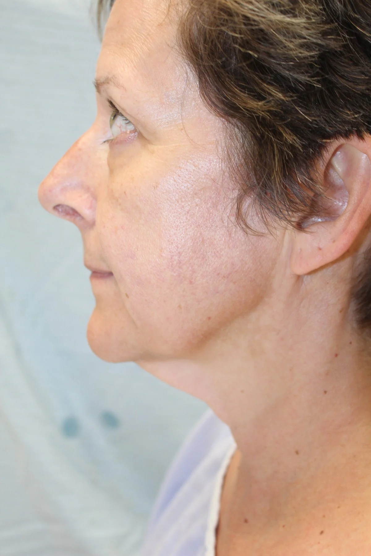 Patient H Preoperative Facelift — Dr Giuffre Plastic Surgeon Edmonton