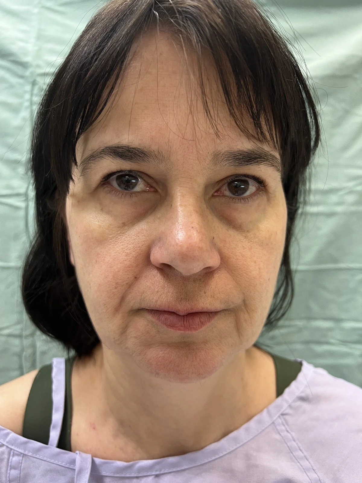 Patient M Preoperative Facelift — Dr Giuffre Plastic Surgeon Edmonton