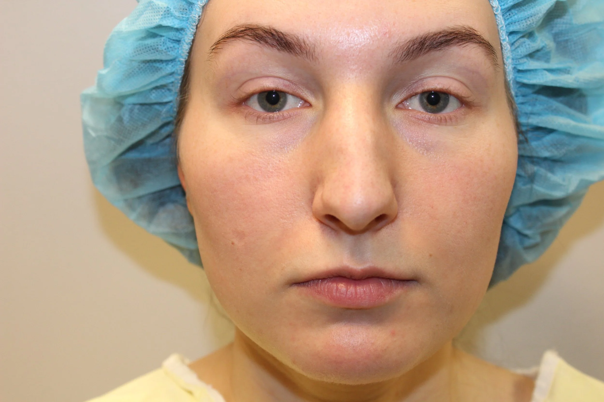 Patient J PreOperative Rhinoplasty — Dr Giuffre Plastic Surgeon Edmonton