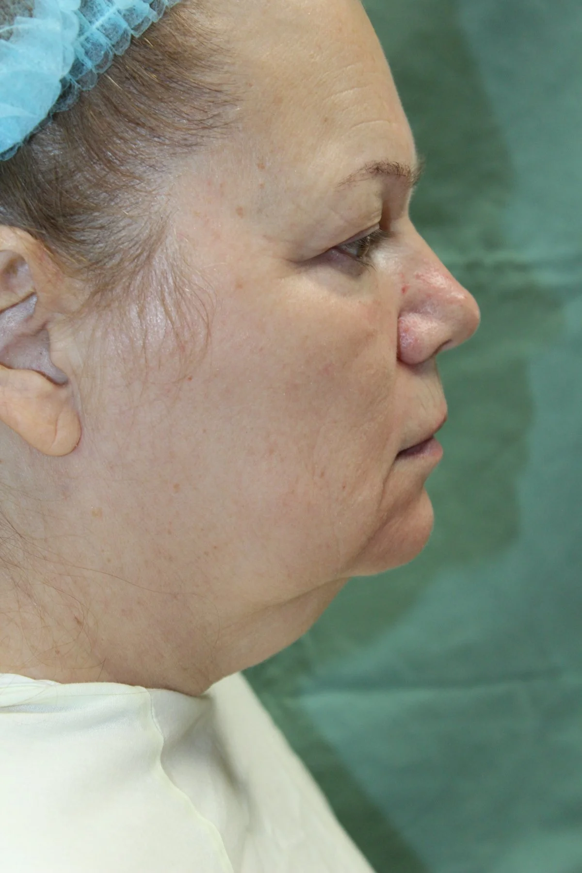 Patient K Preoperative Facelift — Dr Giuffre Plastic Surgeon Edmonton