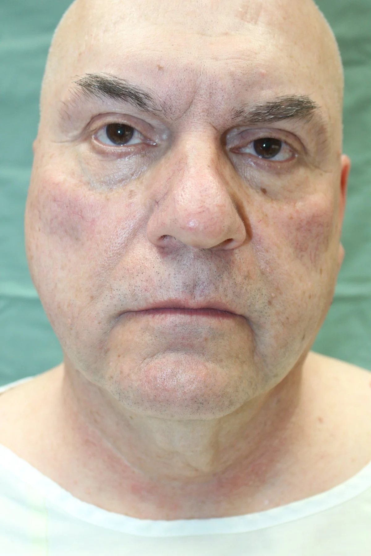 Patient V Preoperative Facelift — Dr Giuffre Plastic Surgeon Edmonton
