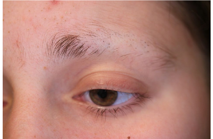 Patient-with-trichotillomania-presenting-with-irregular-patchy-alopecia-of-the-eyebrow.png