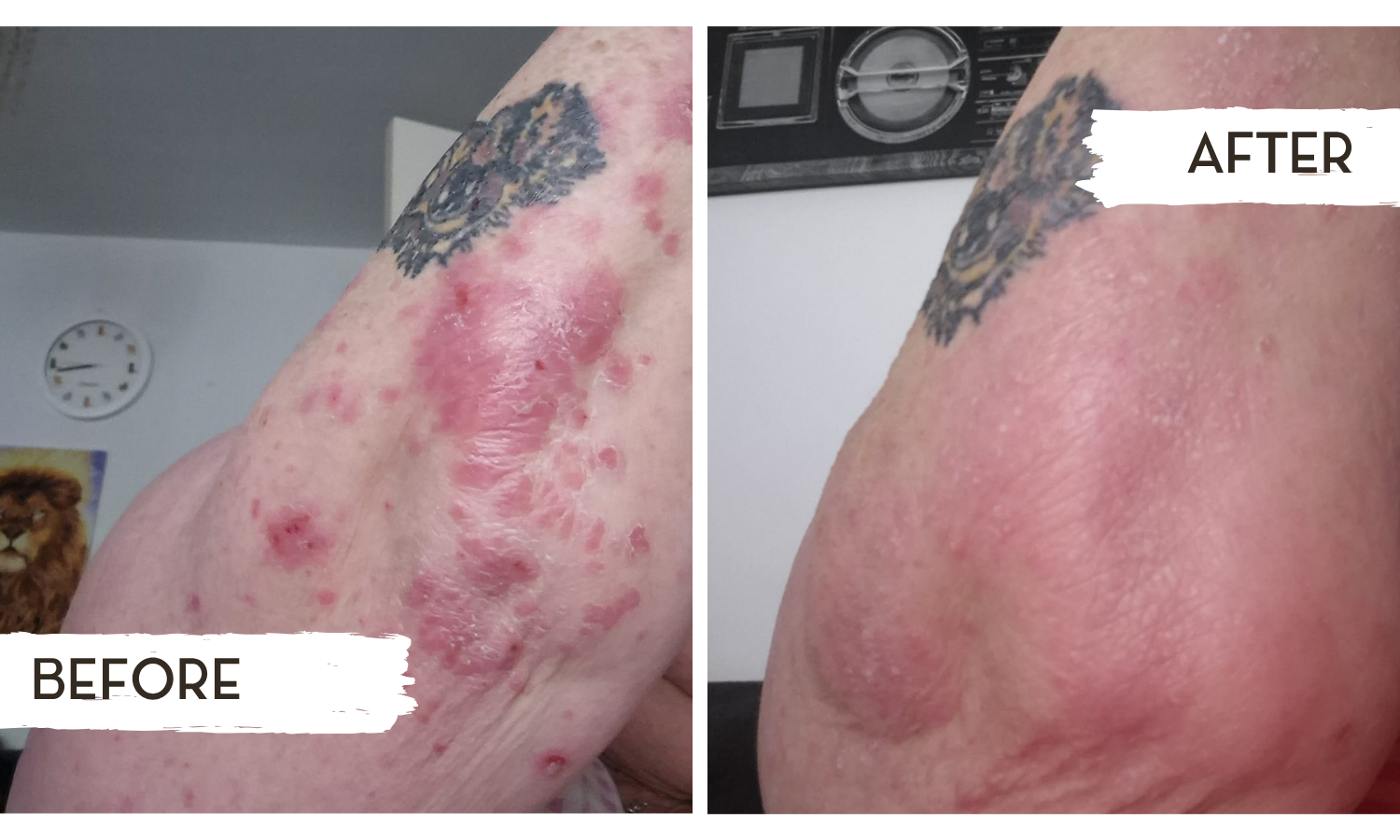 skin support vitamin supplement eczema psoriasis acne