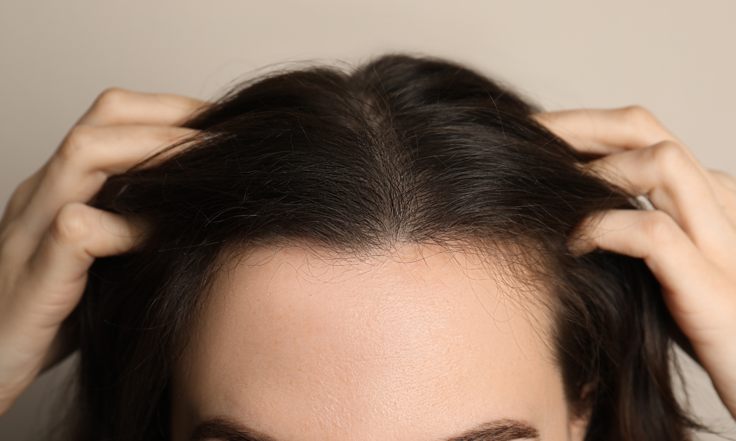 scalp eczema