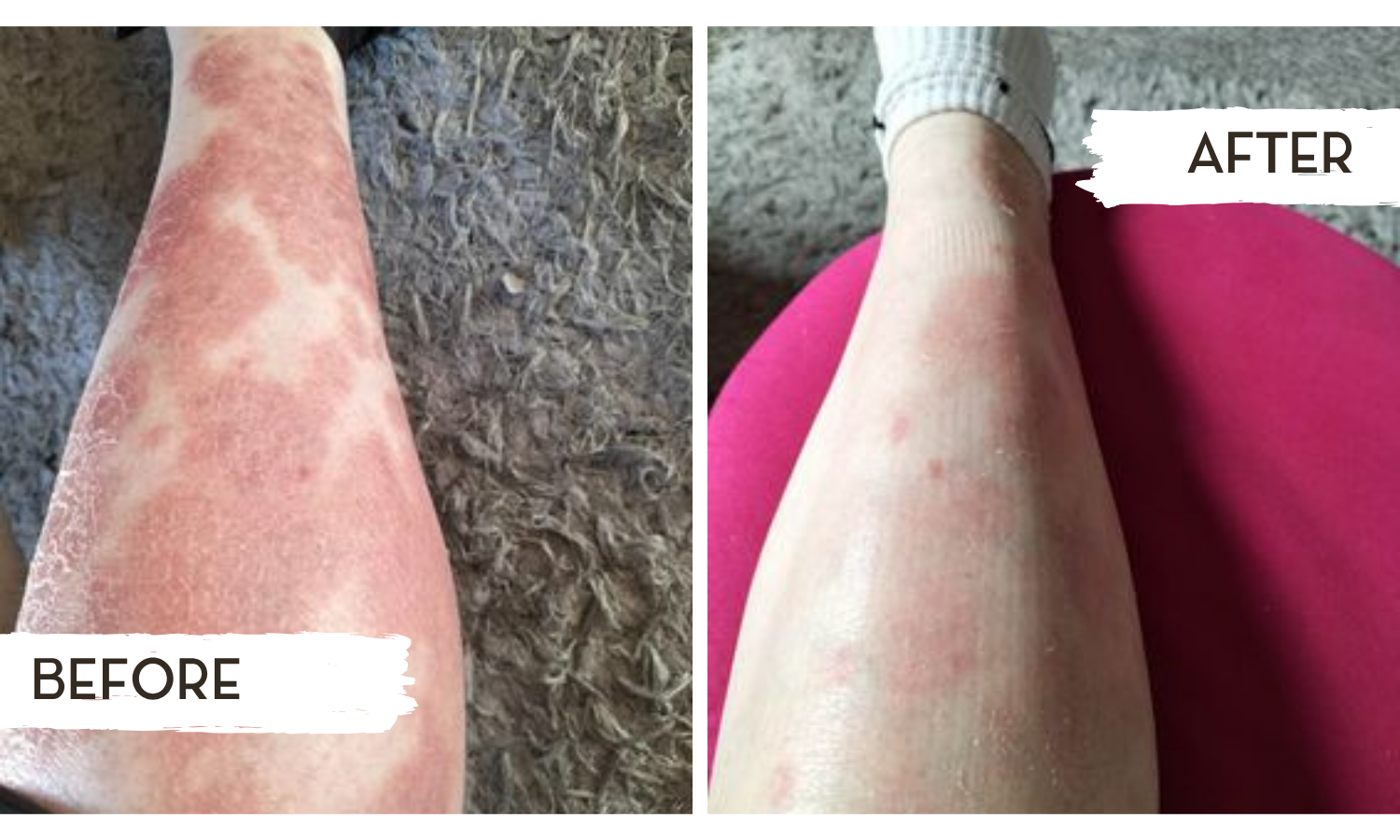 skin support vitamin supplement eczema psoriasis acne