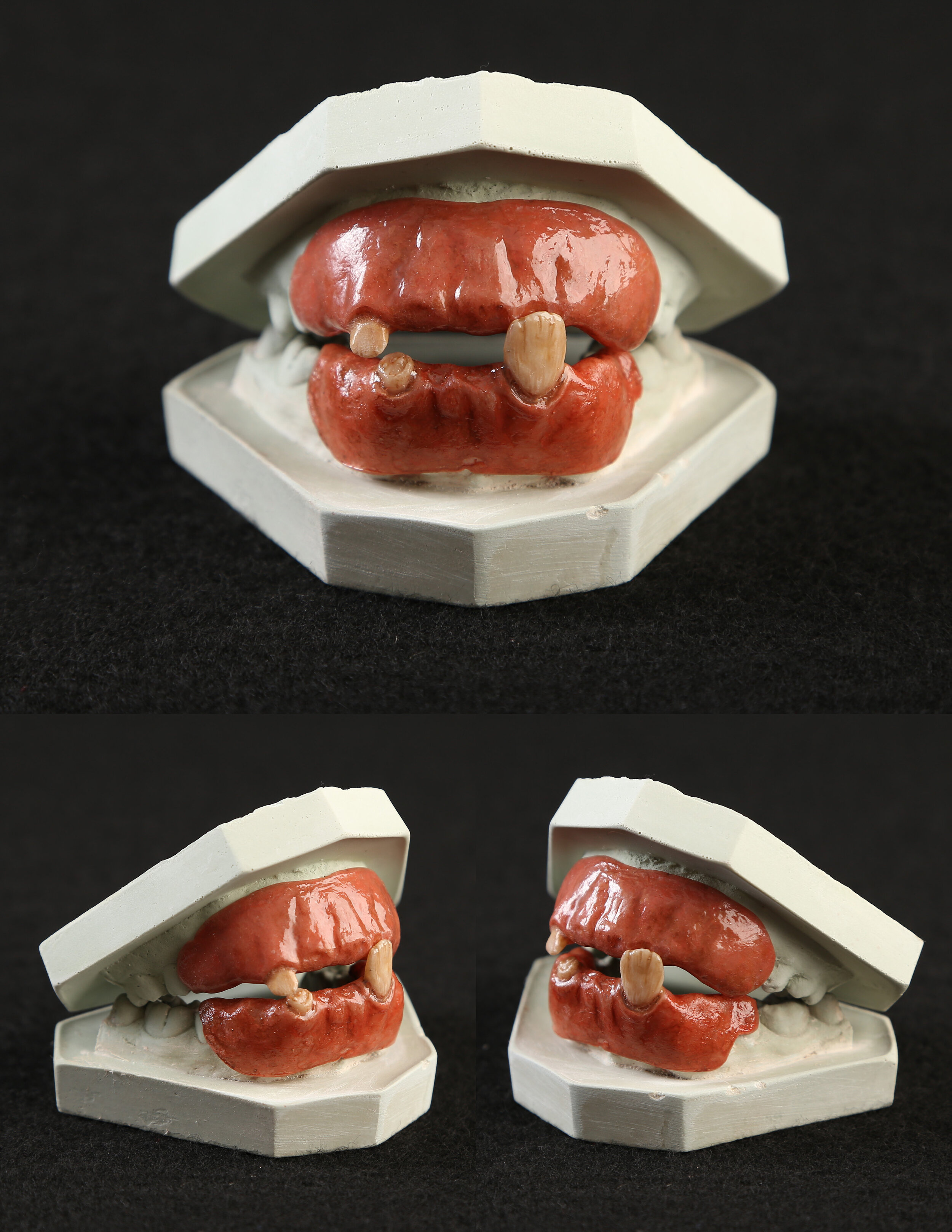 custom dentures were made from a cast of the model's teeth.