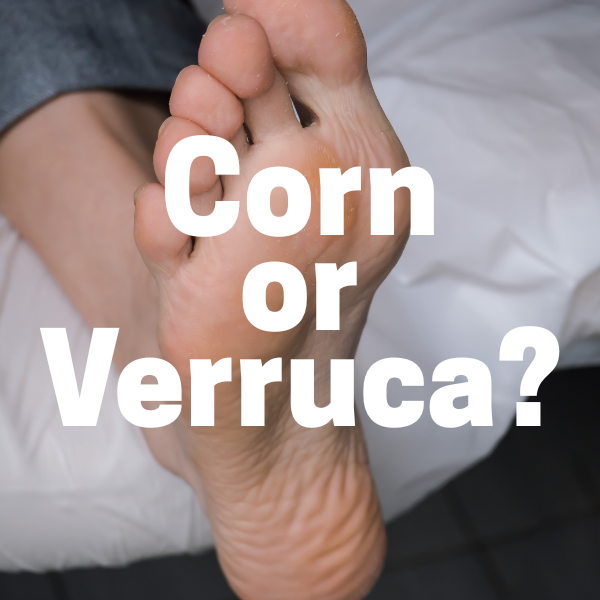 How to tell the difference between as verruca and a corn.