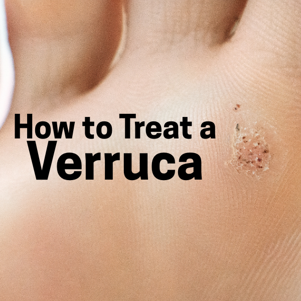 How to treat a verruca.