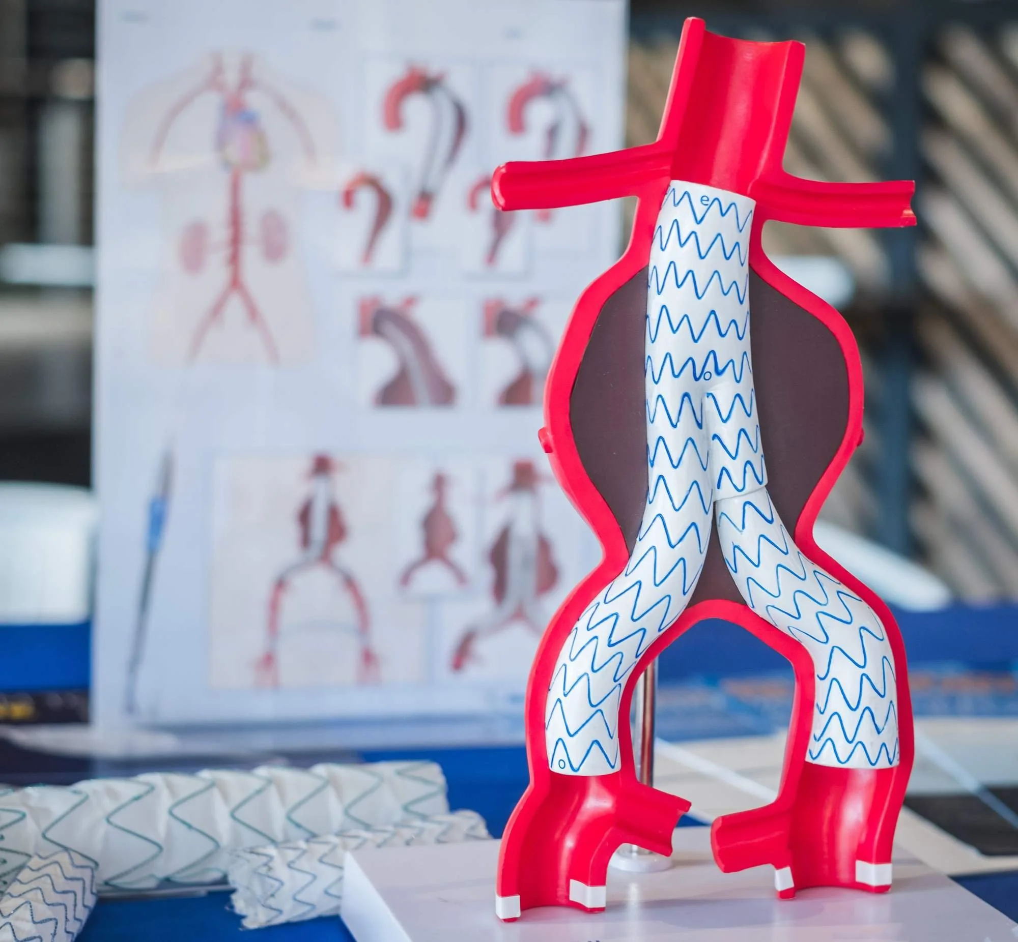 Model of the aorta with a Y-shaped stent graft lining an abdominal aortic aneurysm