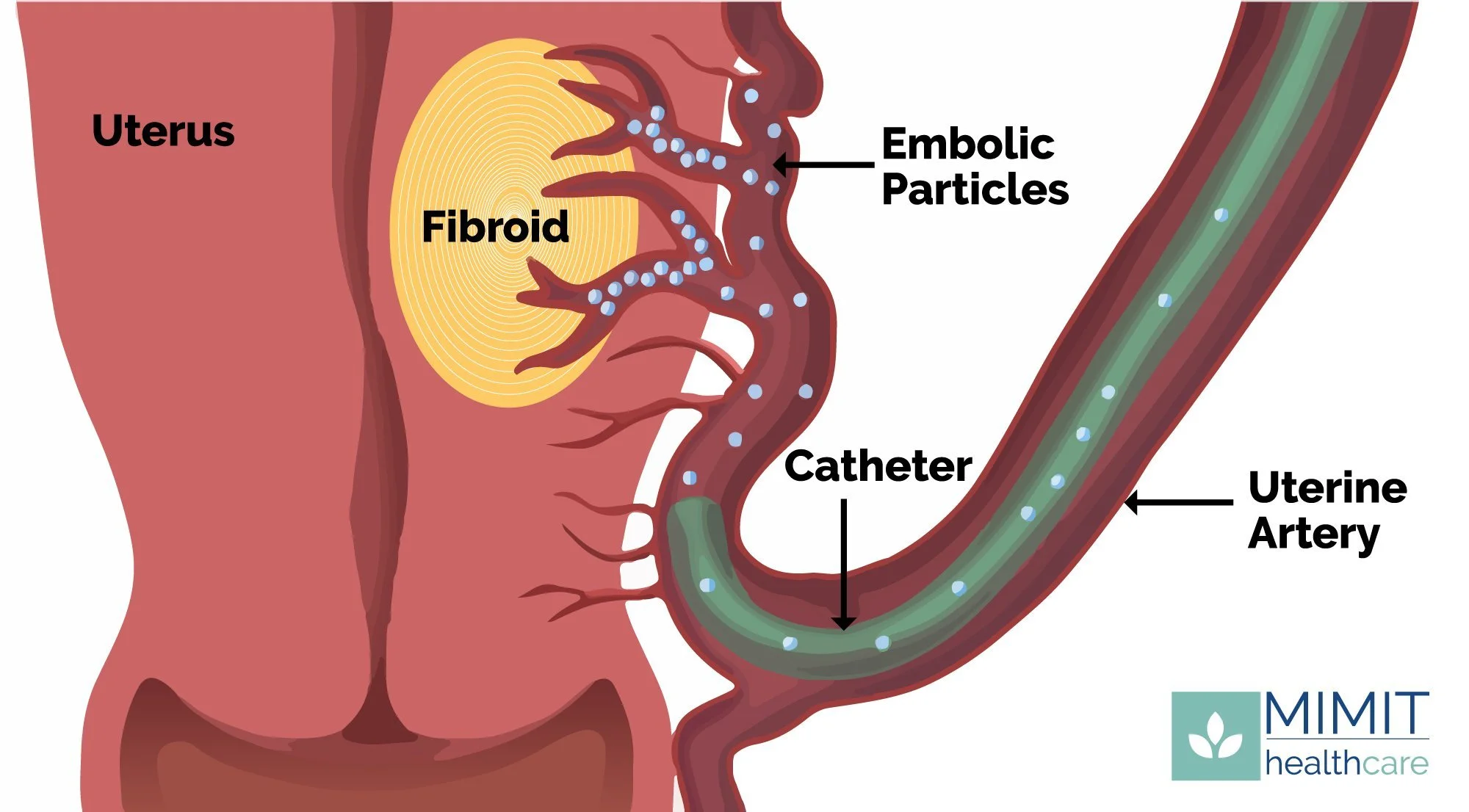 Uterine Fibroid Embolization UFE MIMIT Health Uterine Fibroid Embolization UFE MIMIT Health