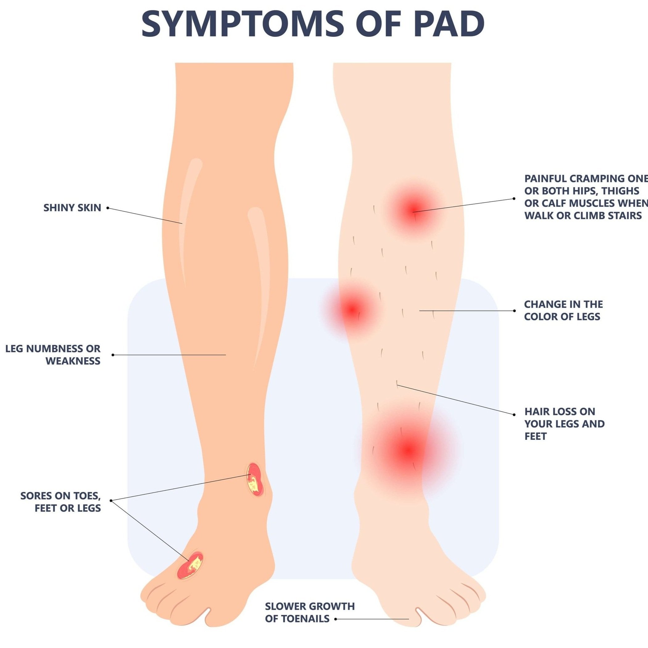 Blocked artery in leg symptoms deals