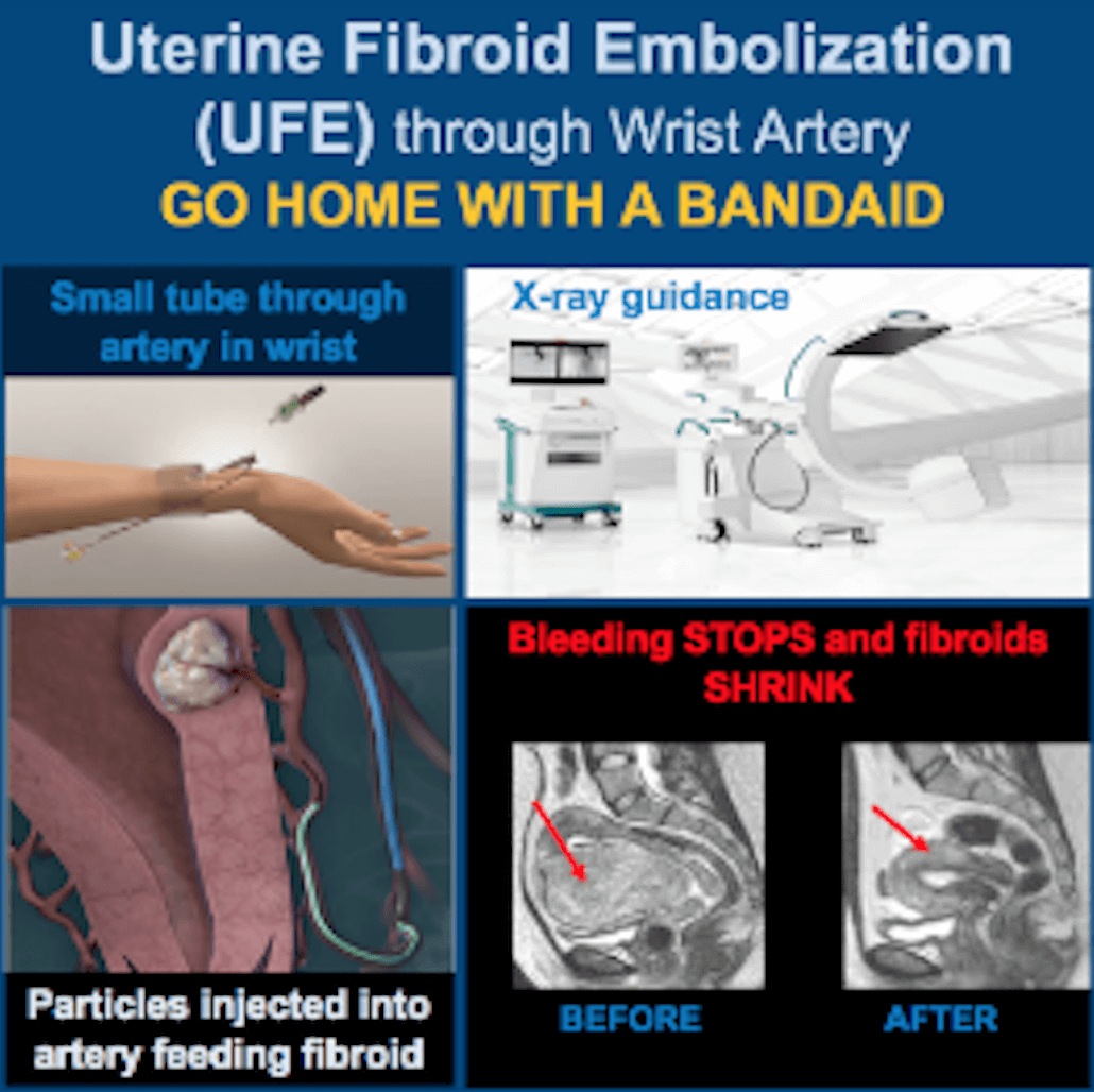 How Fibroids Are Removed with Uterine Fibroid Embolization