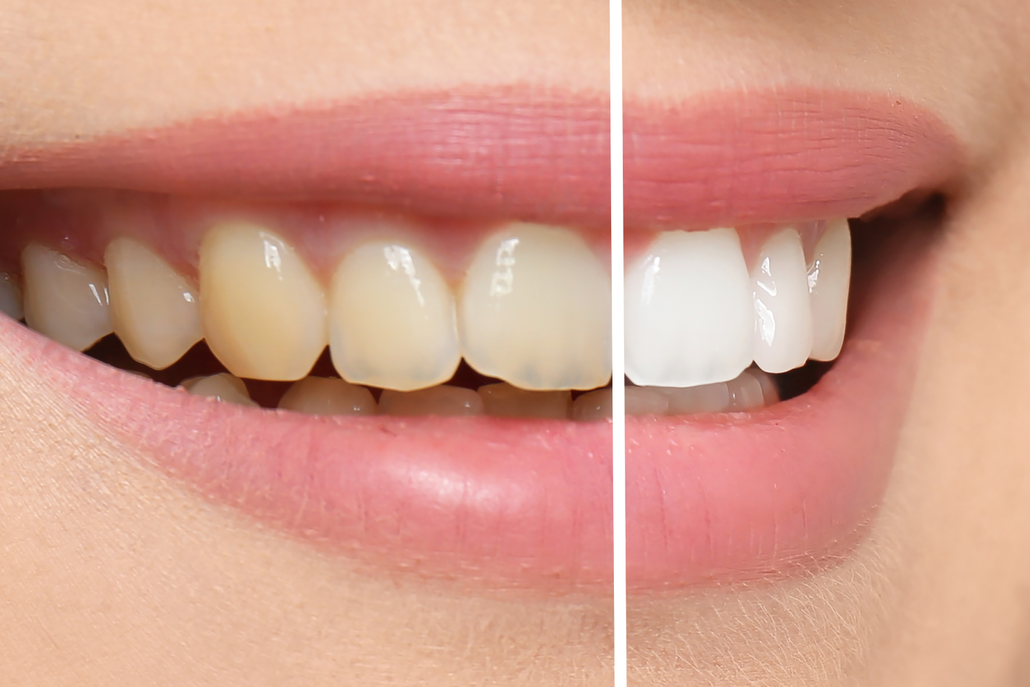Causes of Tooth Discolouration – All Teeth Are Not The Same!