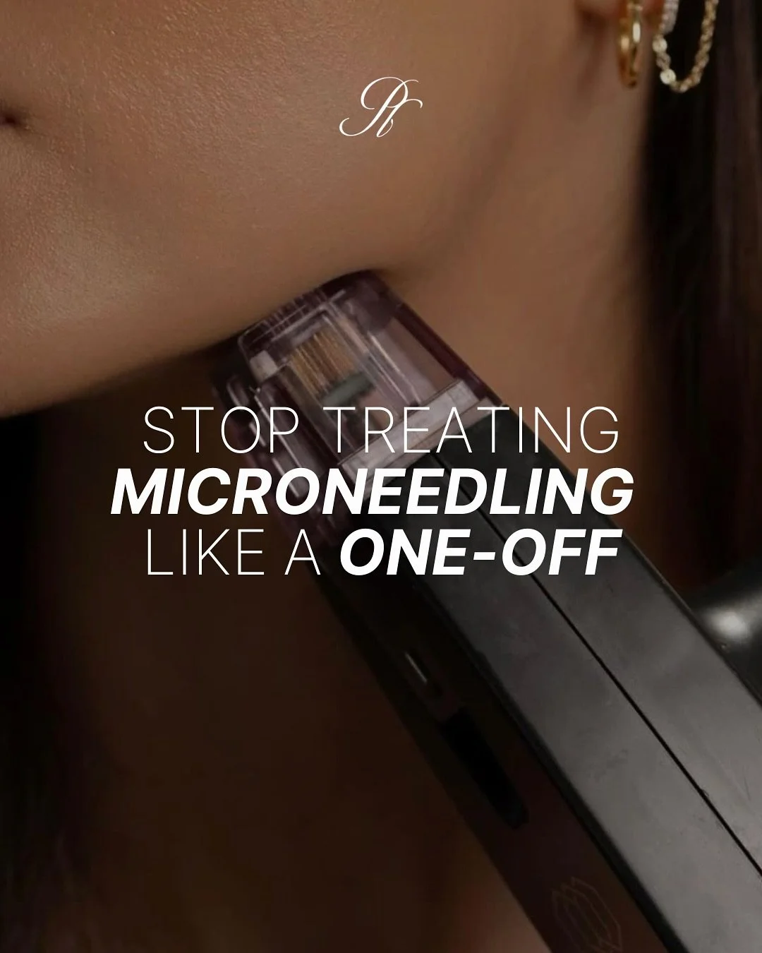 Stop treating microneedling like a one-time miracle 🤍😭

Collagen has a timeline! Over time, our natural production slows down, that&rsquo;s why consistency with microneedling is key 🔑 

When you book a microneedling treatment every 4&ndash;6 weeks