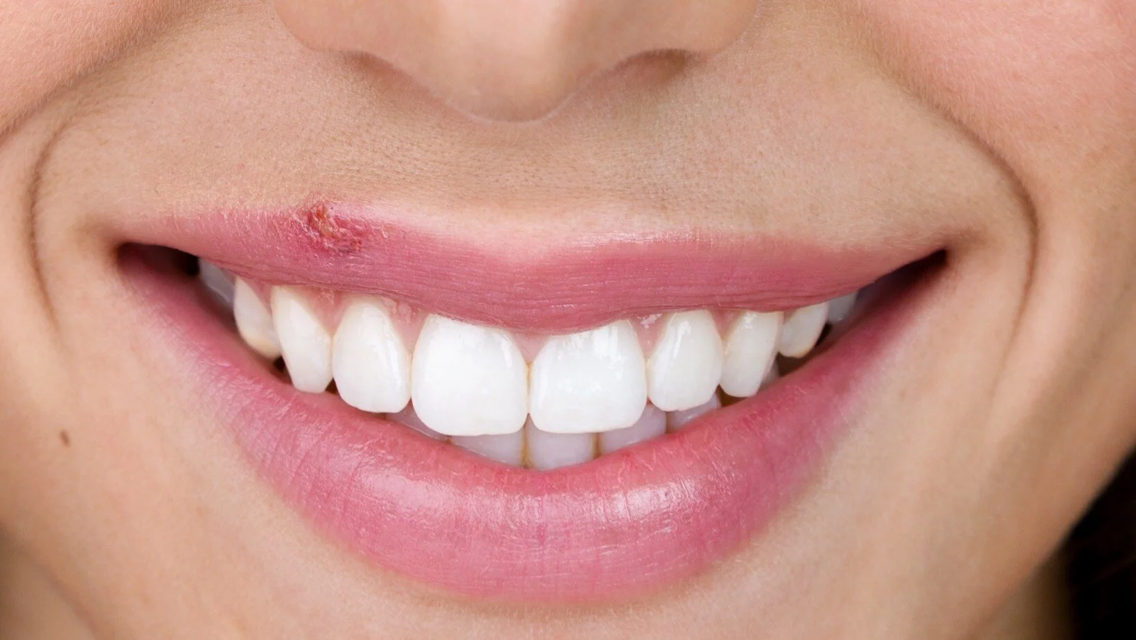 Cold Sores (HSV-1) and Dental Treatment.