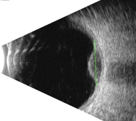 New Frontiers in Uveal Melanoma
