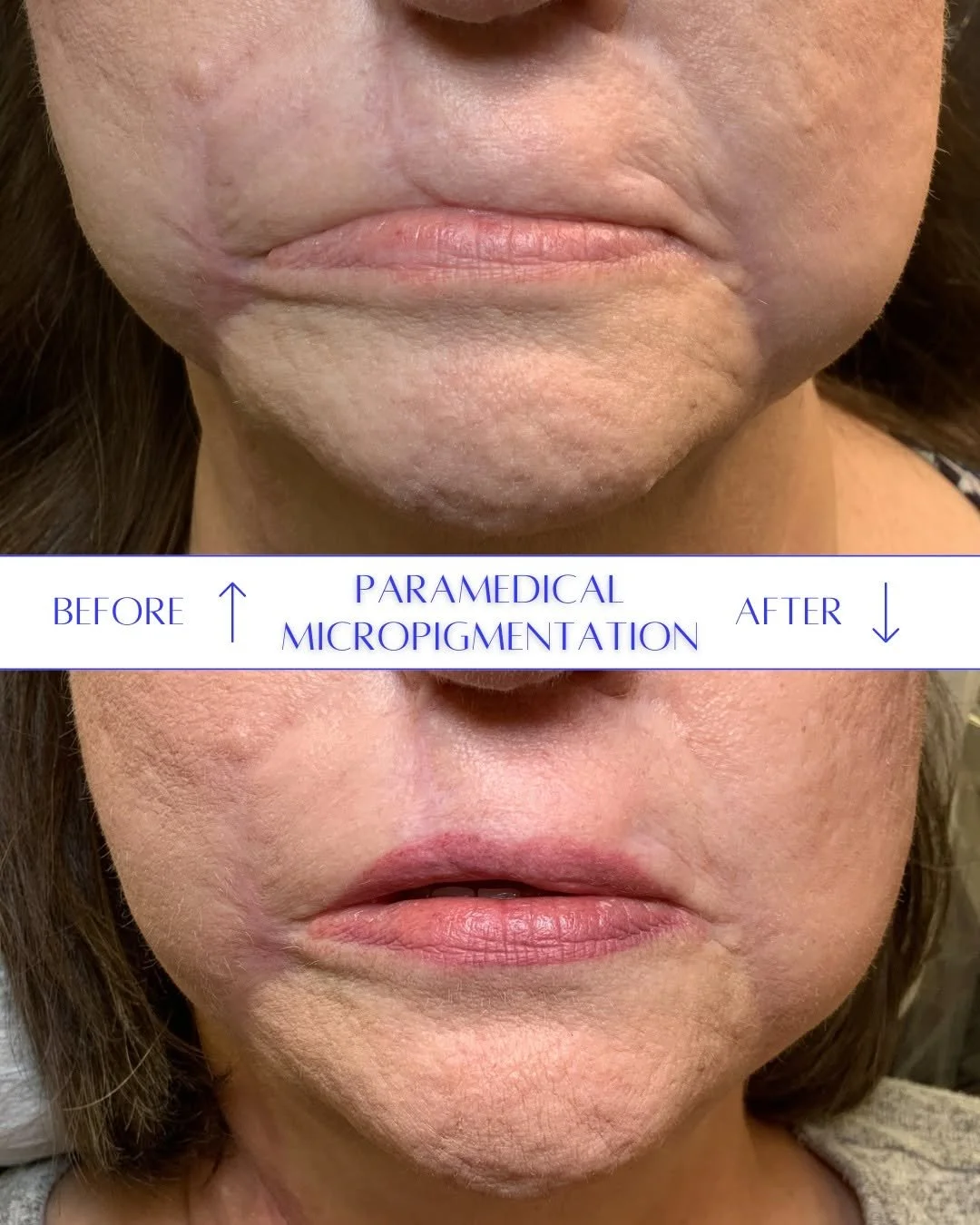 skin cancer scar camouflage, skin cancer removal and reconstruction, lip scarring, paramedical micropigmentation in oklahoma, moss surgery scar