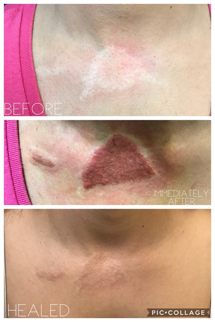 Scar camouflage & scar tattooing, scar solutions or scar revision) okc oklahoma — Erin Meier Aesthetics Scar camouflage & scar tattooing, scar solutions or scar revision) okc oklahoma — Erin Meier Aesthetics