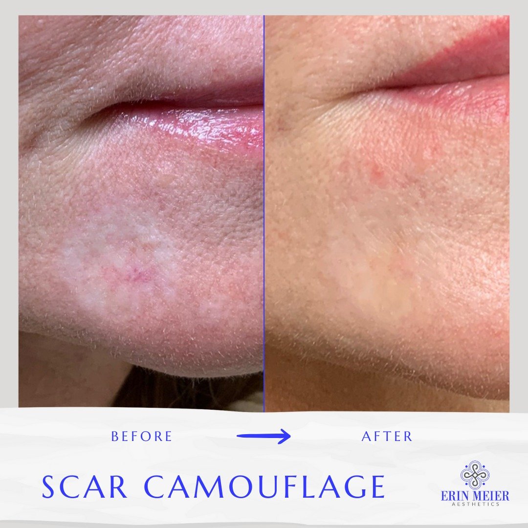 ✨ Scar Camouflage Transformation ✨

This before and after shows the amazing results after just 2 sessions of scar camouflage for a radiation burn from skin cancer treatment. We are absolutely thrilled with the progress and so grateful to help our cli