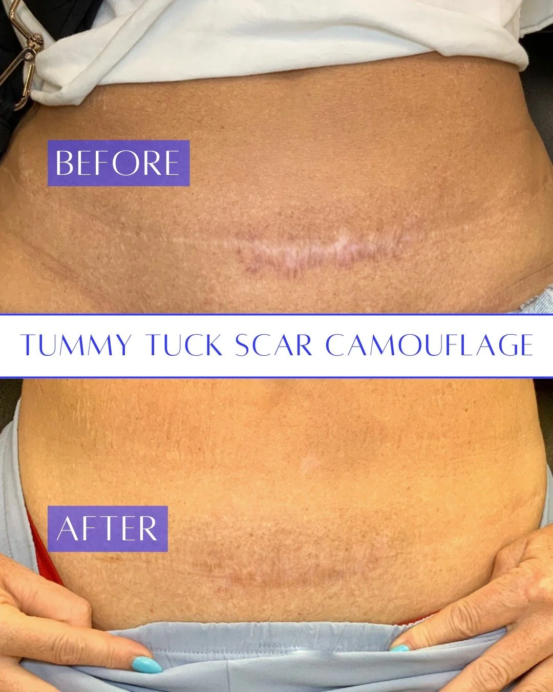 This is why I love what I do! ❤️ Beautiful healed results after a second session of scar camouflage on a tummy tuck scar. It's truly amazing to see the confidence that comes with these results. I've significantly blended and softened the scar, creati