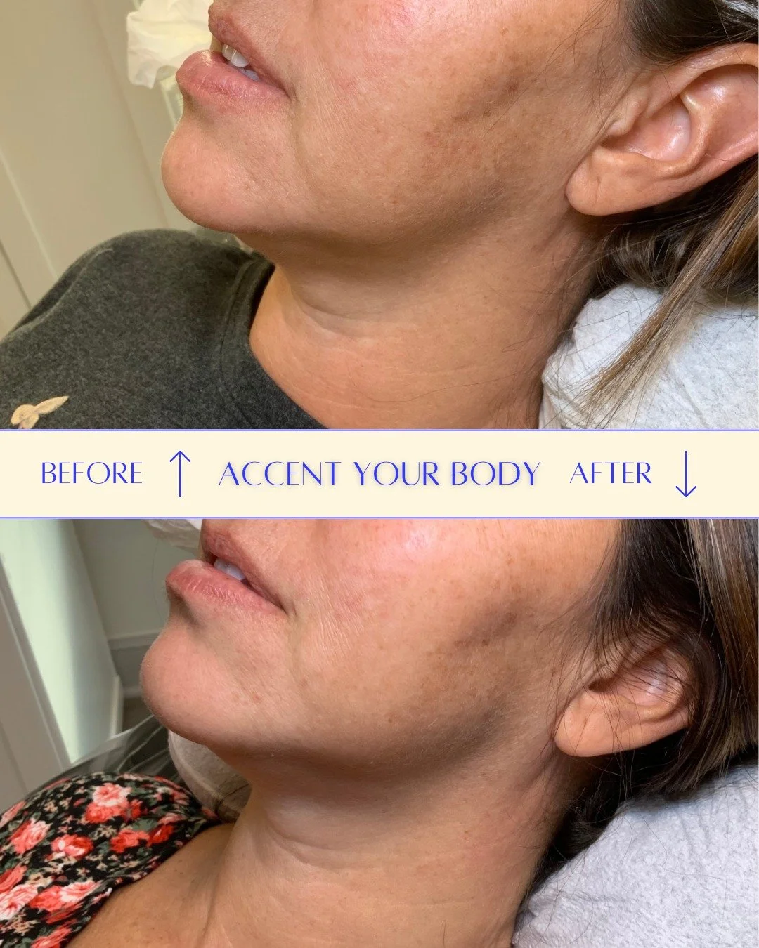 Want a sculpted jawline without surgery or downtime? 🤨

I've got you covered !🙋&zwj;♀️

This client is already seeing incredible results after just two treatments of Accent Your Body skin tightening, spaced two weeks apart. There was no downtime wh