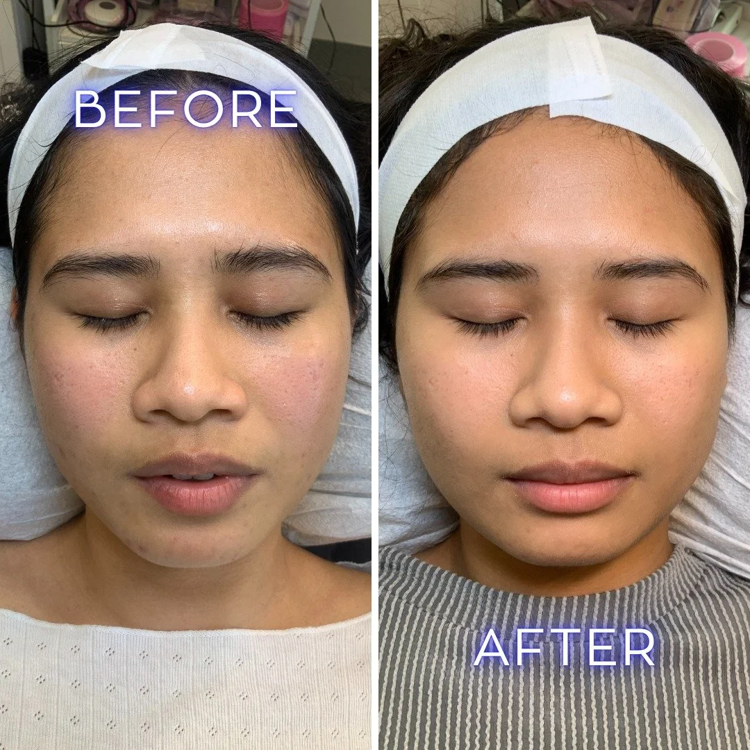 TWO SESSIONS. HUGE IMPACT! 💥
Just look at this incredible Microneedling transformation! This client had 2 treatments (4-6 weeks apart).
✔️ Significantly reduced acne scarring
✔️ Boosted overall skin health and radiance
✔️ A clearer, more even comp