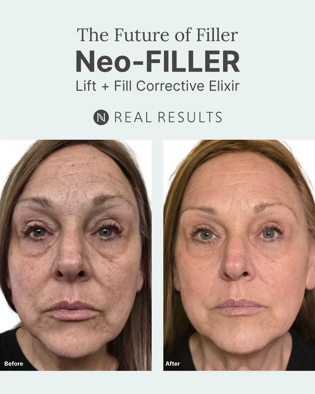 🚨Stop scrolling!🚨 If you're looking for that one transformational product for your skin, this is it! 🎯
Discover Neora's Neo-Filler - Lift and Fill Corrective Elixir💫
This powerful serum contains a proprietary GFP-STEM blend of growth factors, p