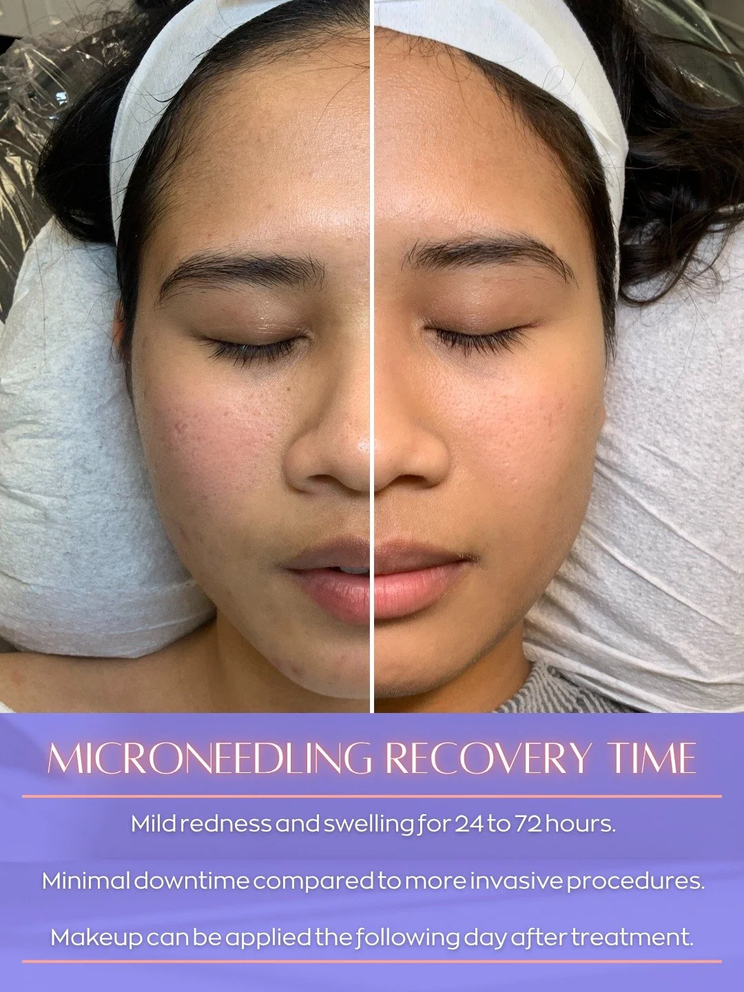 Microneedling Recovery: What to Expect!

Are you considering microneedling but curious about the downtime? The recovery process is simple and quick!

Here&rsquo;s the rundown on what your skin will experience:

🔹Mild Redness &amp; Swelling: Expect a