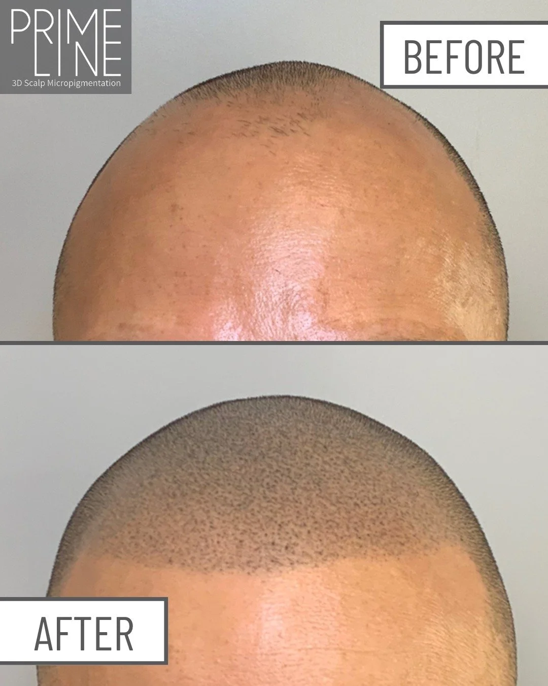 ✍️ Second Session Success! ✍️

Check out this amazing progress! I'm thrilled to share the Before and After photos from this client's SECOND Scalp Micropigmentation (SMP) session here at Prime Line OKC.

You can see how the second layer of pigment imm