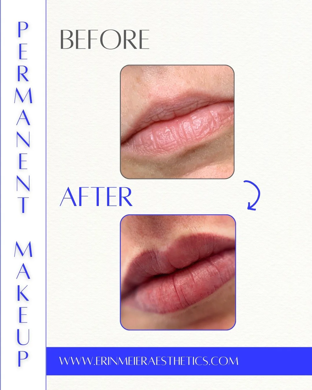 Fresh off the needle! 💉👄

Take a look at this beautiful lip blush transformation, immediately after the procedure.

During the healing process, this pigment will soften by about 20%, settling into a soft, natural tint.

🔷 Restored the vermilion bo