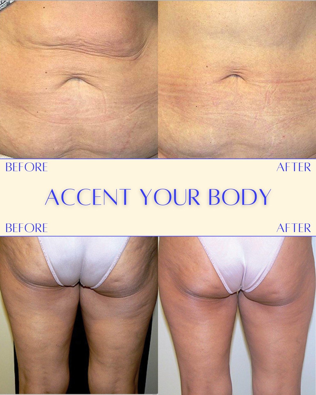 Summer bodies are made in January. ☀️👙

Obsessing over these Accent Your Body results on the stomach and the glutes to tighten skin and reduce cellulite!

Start your countdown to summer and DM me "ACCENT" to get more info!

#AccentYourBody
