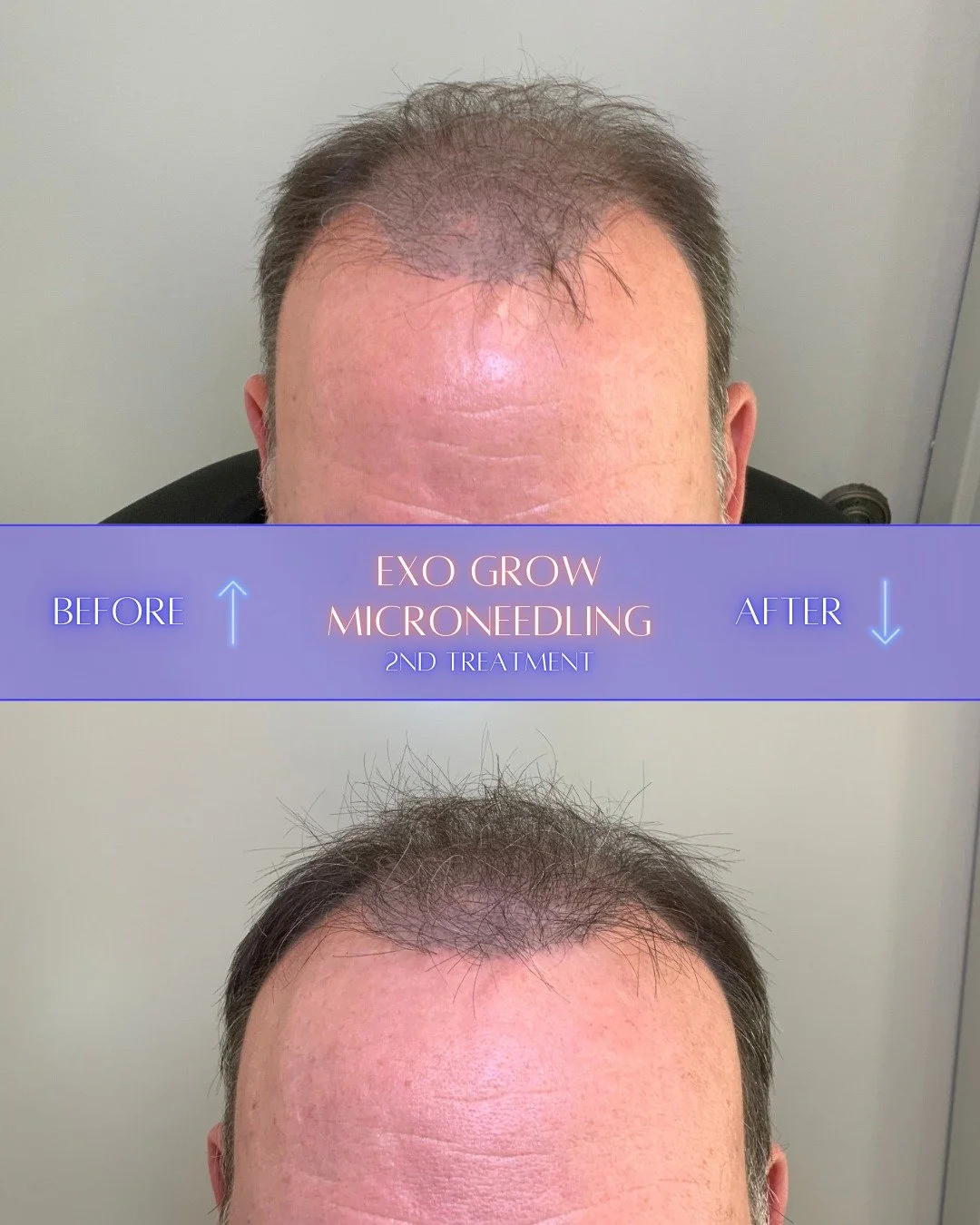 Results after two sessions of Exo-Grow Microneedling🔥

By combining the precision of microneedling with the regenerative power of high-potency exosomes, we are waking up dormant follicles and strengthening existing hair from the root. While hair res