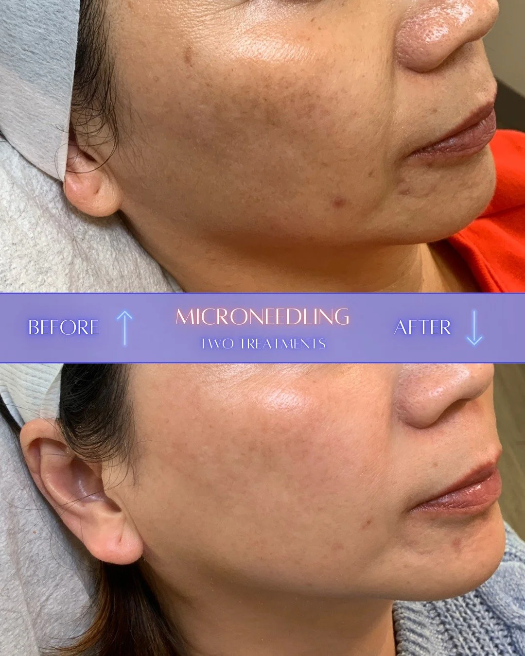 The magic of just TWO sessions! 🪄

It is incredible to see how the skin responds when we focus on true cellular restoration.  After only two microneedling treatments,  this client's skin complexion has completely transformed.

Let&rsquo;s break down