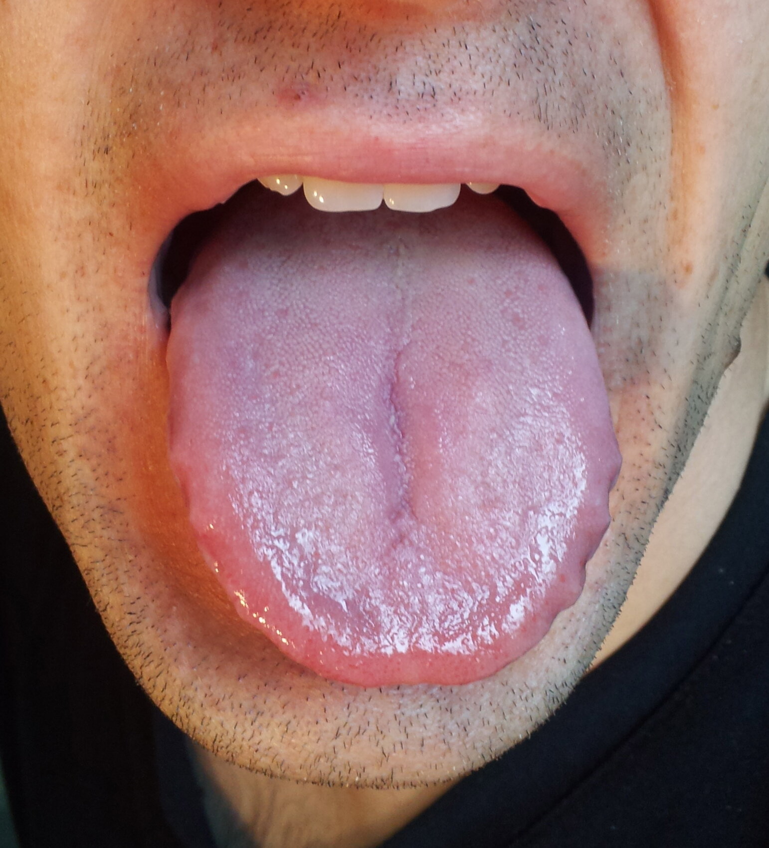 normal tongue coating