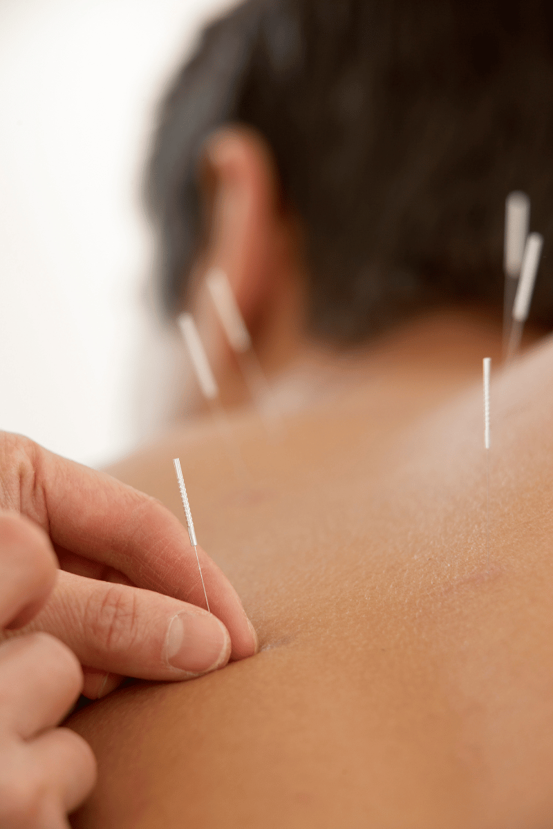 A patient with acupuncture needles in her body