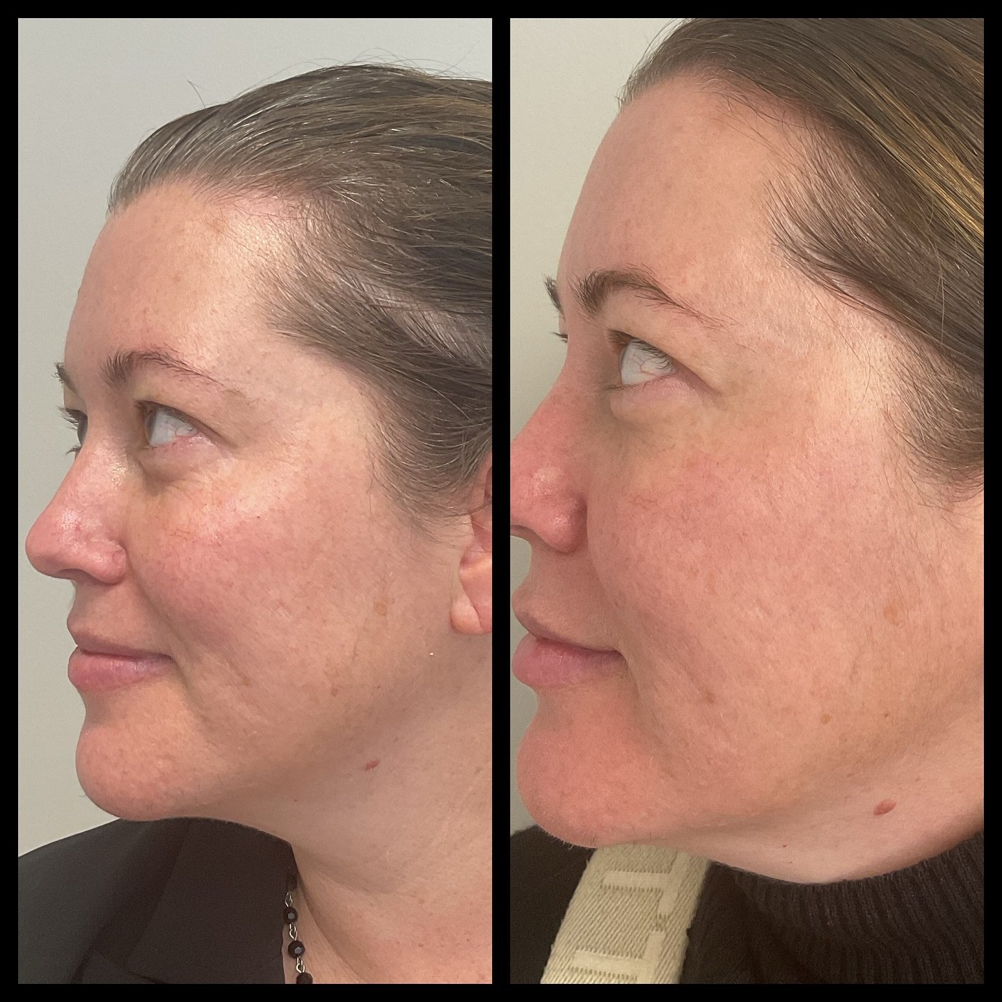 Before and after from my glass laser at @revivahairskinclinic 😍 going back to get more texture resurfacing in January 🥰