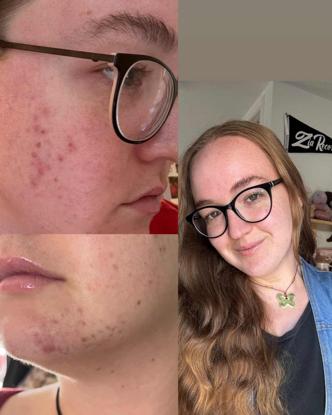 Ally acne
