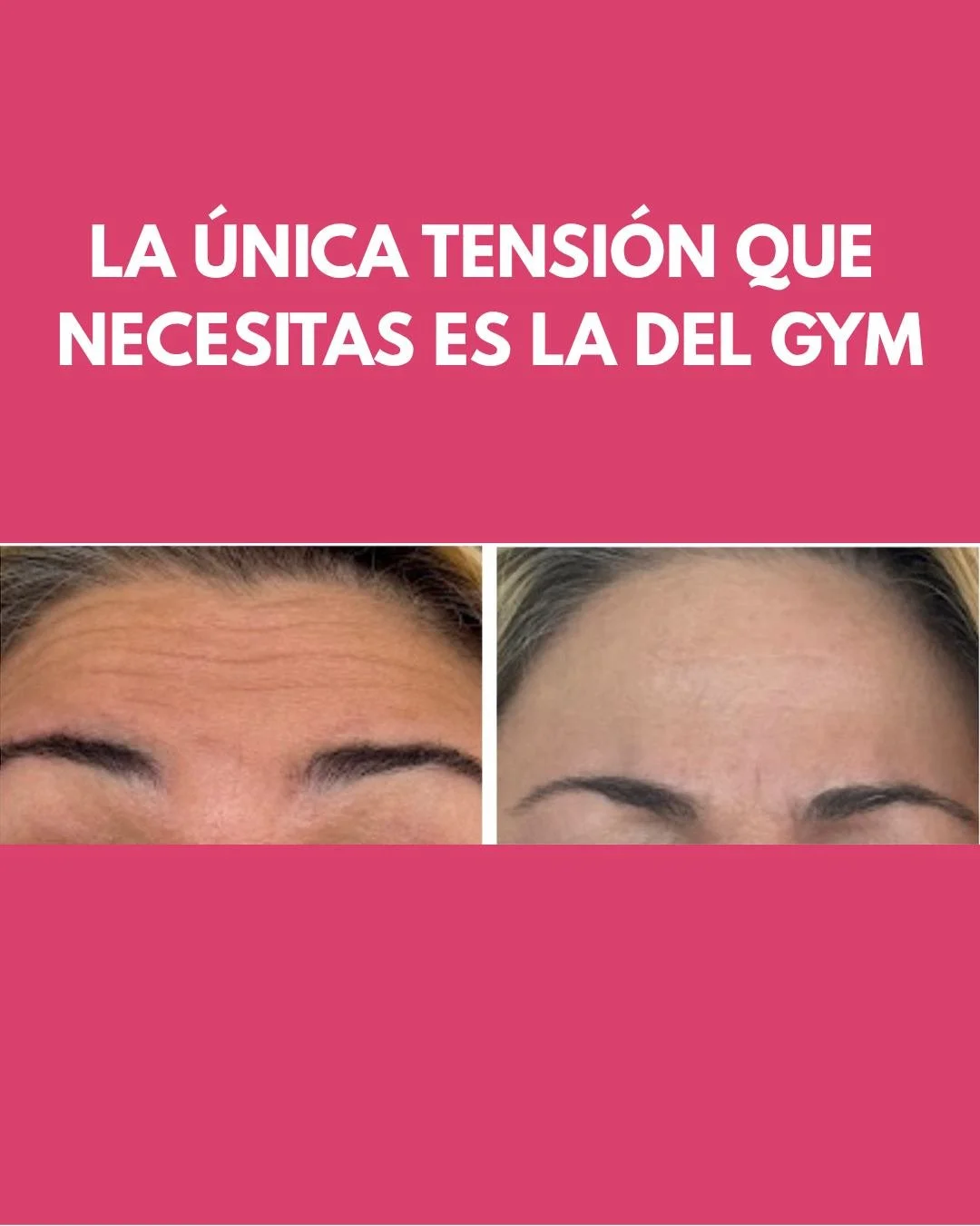 Programa tu evaluacion con el Dr Edgardo Rivera Escobar y elimina esa tension! #medpsalife #smoothskin #glowup #bluesteel #tox #jeauveau