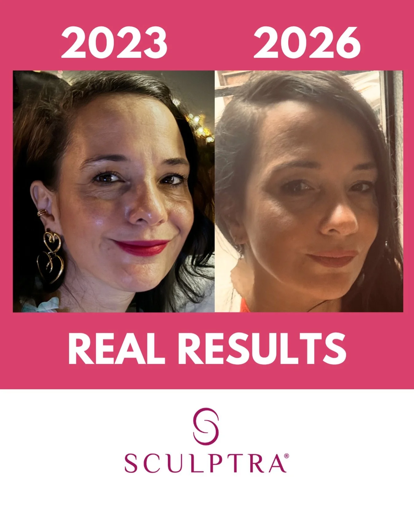 Al paciente se le administr&oacute; Sculptra en diciembre 2025 y ya dos meses despu&eacute;s ha tenido resultados impresionantes. #sculptra #galderma #injectables #tox #fillers