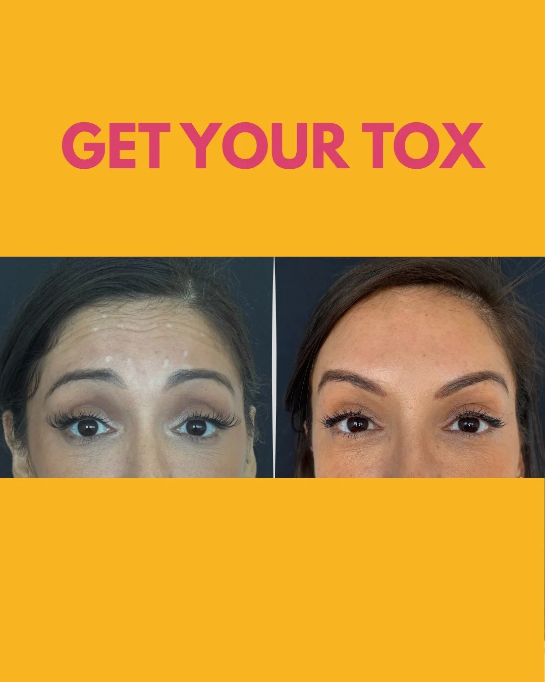 Los neuromoduladores ayudan a relajar las l&iacute;neas de expresi&oacute;n causadas por el movimiento repetitivo. Los fillers, por otro lado, restauran volumen, suavizan surcos y realzan contornos. Dos tratamientos diferentes, dos funciones diferent