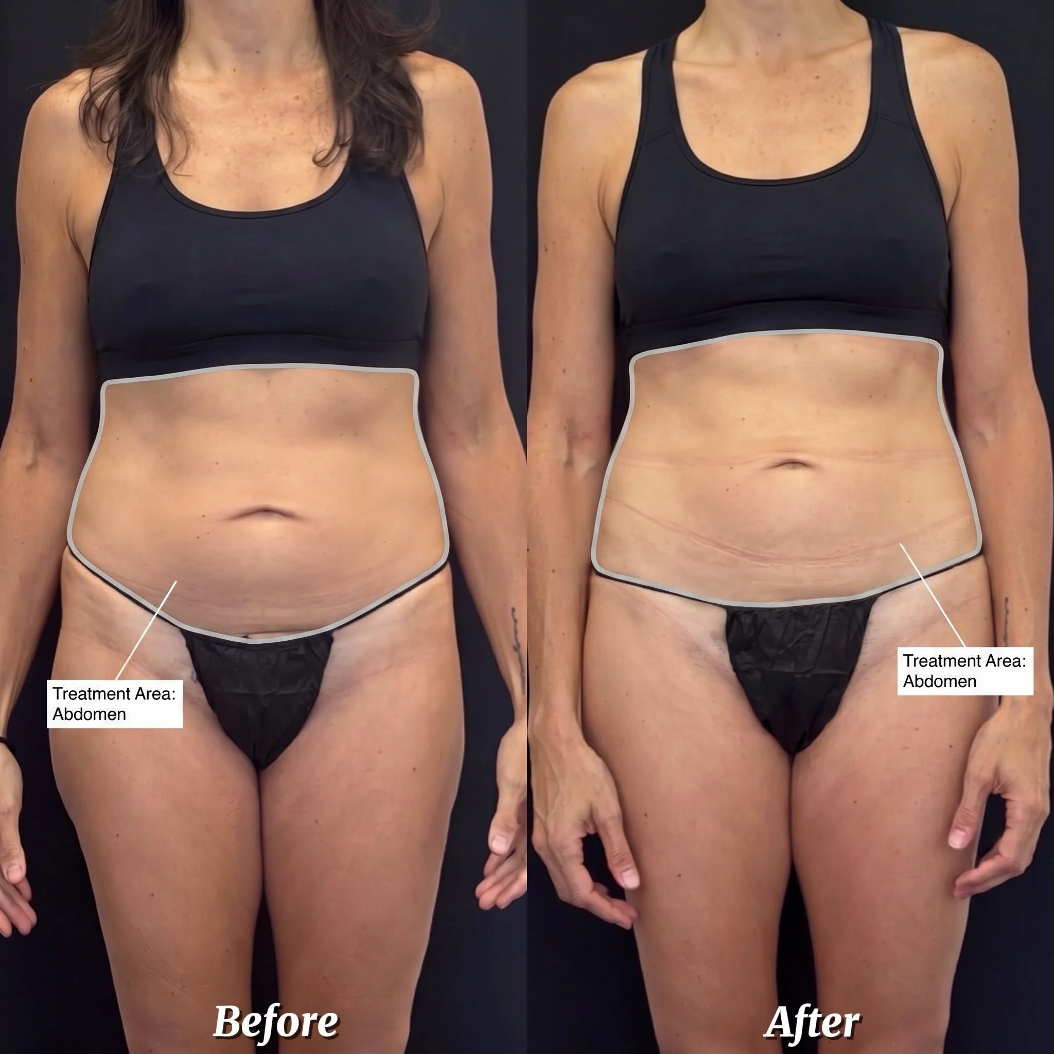 Veronica&rsquo;s Journey apenas comienza 🌟

Con solo 1 sesi&oacute;n de Sculpt Wave, el cambio ya se nota: abdomen m&aacute;s firme, menos grasa localizada. Imag&iacute;nate lo que viene en los pr&oacute;ximos meses 👀✨